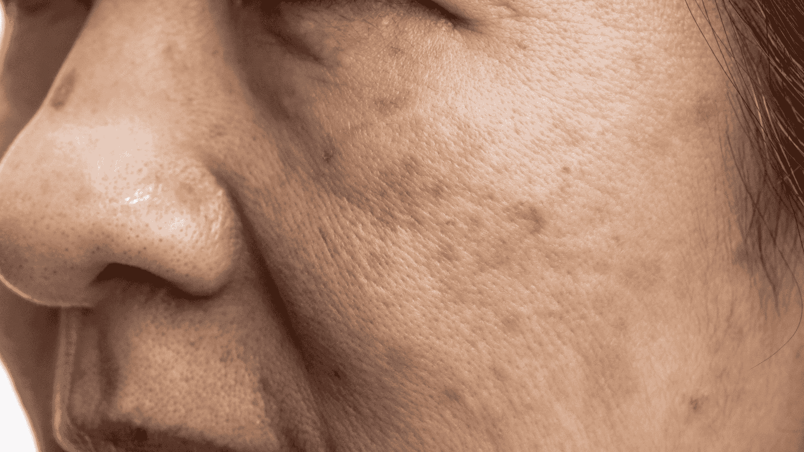 Melasma | Nutrologia e Estética | Dra. Leires Ferreira