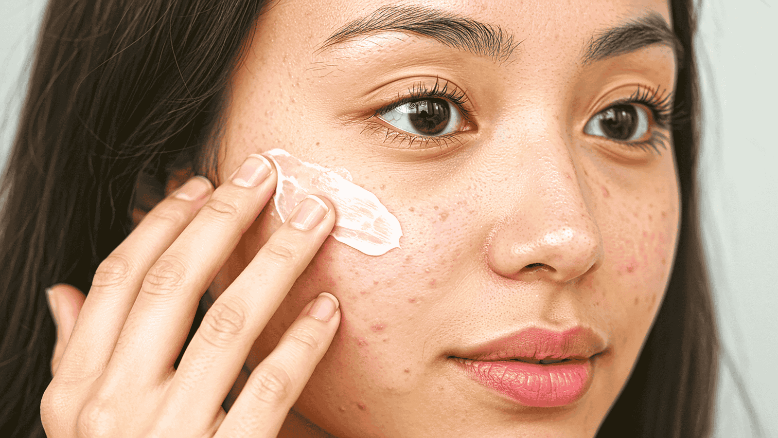 Acne da Mulher Adulta: Combatendo a Inflamação e a Resistência à Insulina com Nutrologia e Dermatologia
