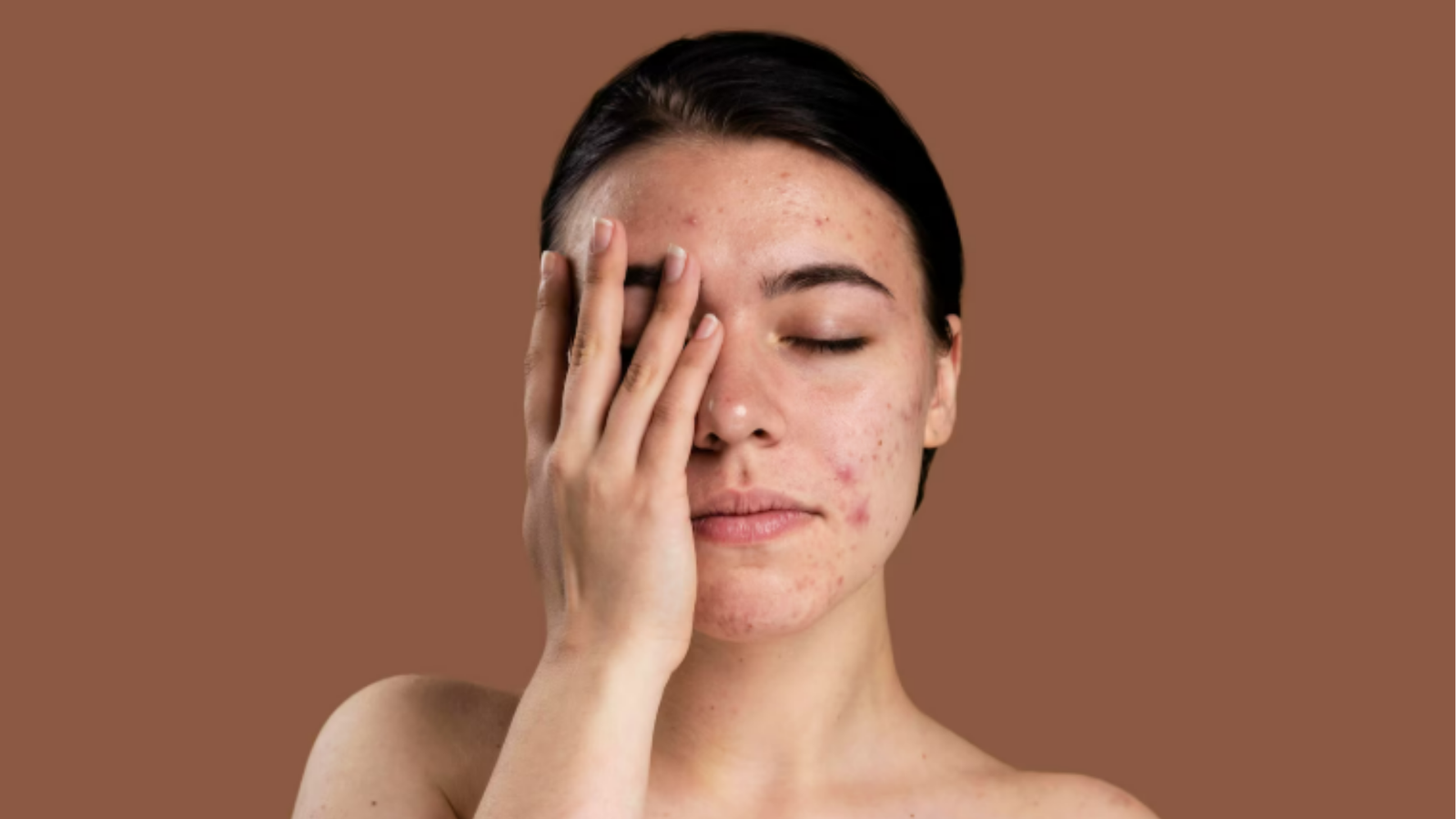 Acne adulta: causas, fatores nutricionais e tratamentos dermatológicos eficazes