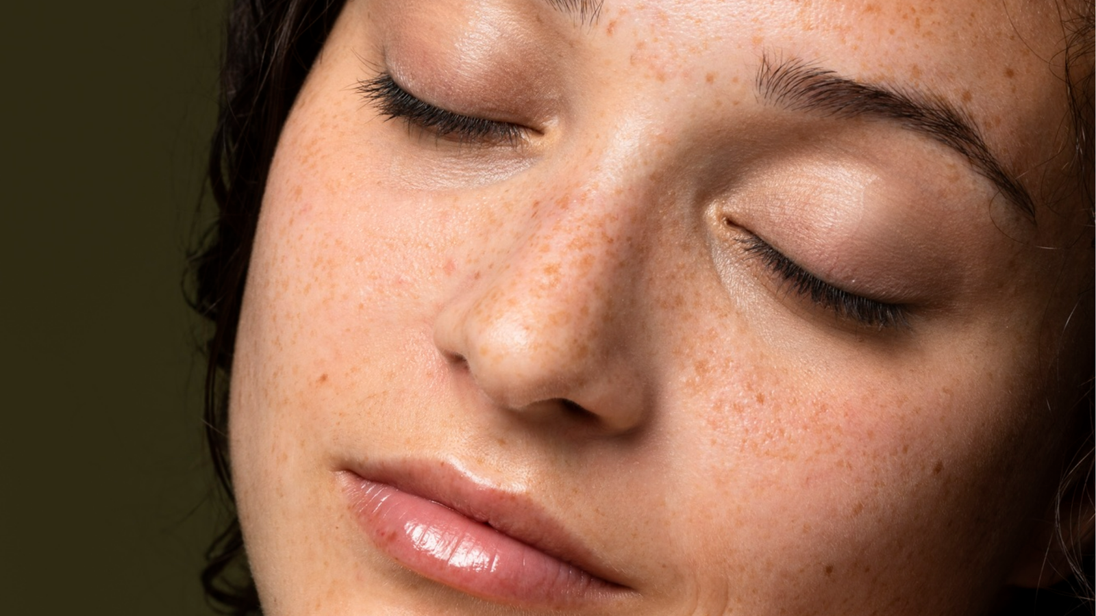 Melasma e nutrição: quais nutrientes ajudam no controle das manchas